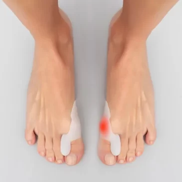 Ochranné silikonové korektory na vybočené palce Bunilief – 2 ks – InnovaGoods